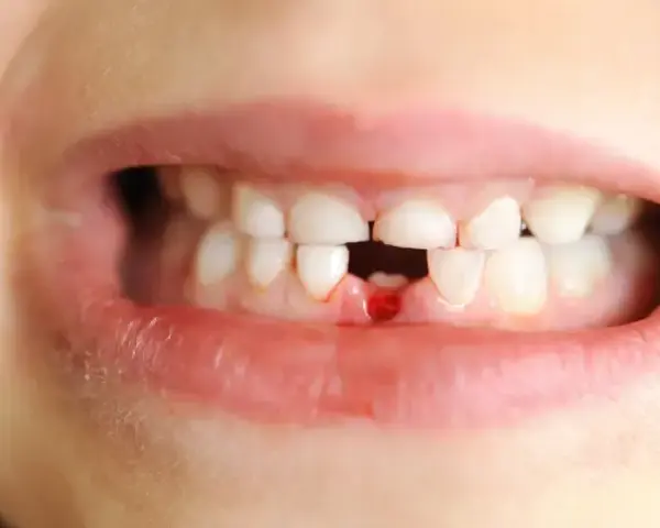 Wypadanie zębów mlecznych: objawy, kalendarz i kiedy do dentysty?