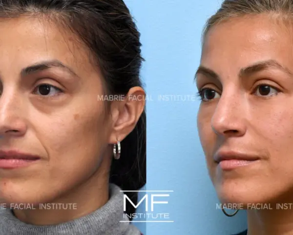 Before and after images show a woman's face, highlighting the reduction of nasolabial folds after a facial massage.