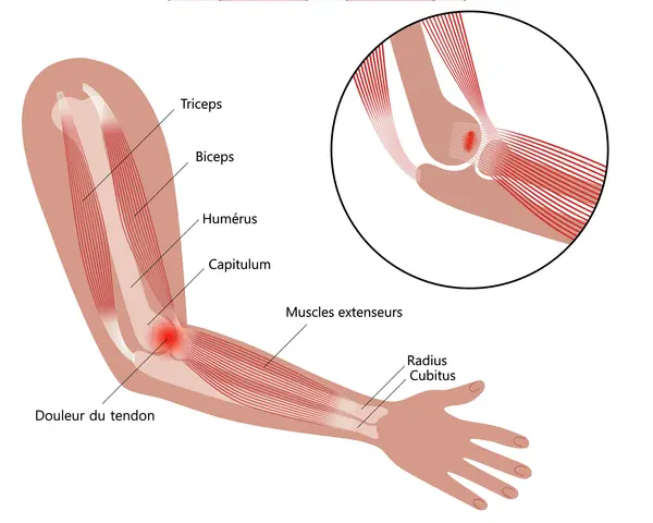 Illustration anatomique montrant une tendinite à l'intérieur du coude, avec douleur au tendon des muscles extenseurs.