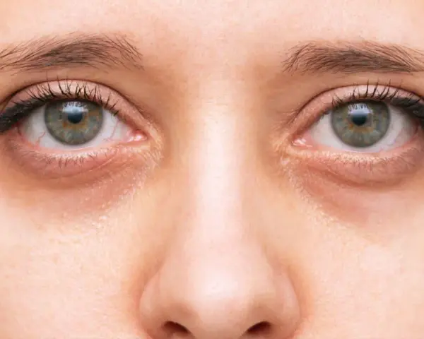 Primer plano de unos ojos con ojeras marcadas. Consejos para como quitar ojeras y lucir una mirada más descansada.