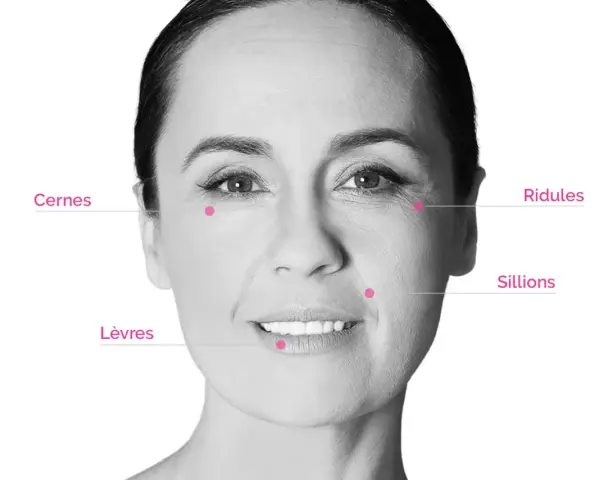 Visage marqué par des rides et cernes. Des points indiquent les zones d'application pour un avis sur l'acide hyaluronique.