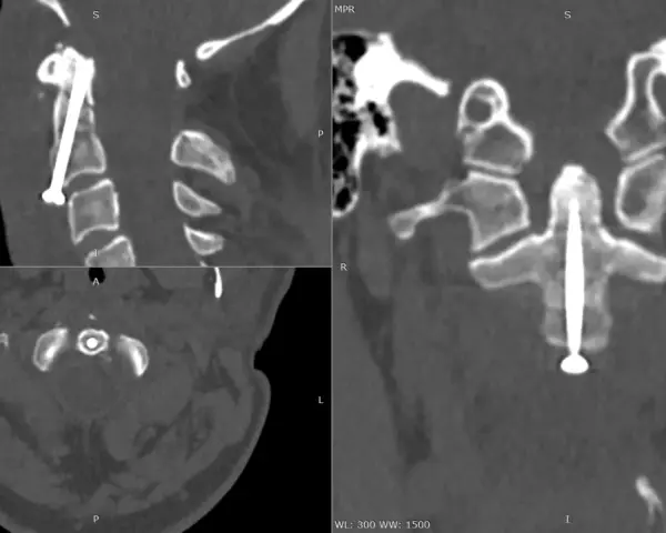 Widok CT kręgosłupa szyjnego po operacji. Widoczny implant stabilizujący, śruba przechodzi przez ząb obrotnika.