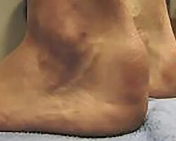 Gros plan sur un talon, suggérant une tendinite du tendon d'Achille. La peau semble légèrement rougie par endroits.