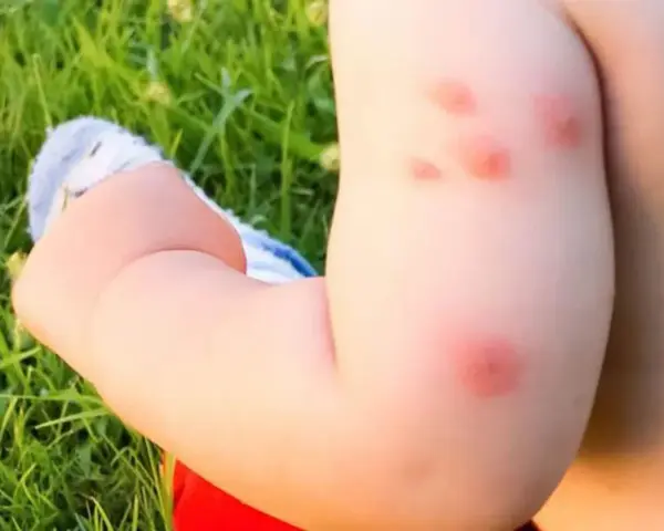 Bebé con varias picaduras de mosquito rojas e inflamadas en su brazo, jugando en el césped.