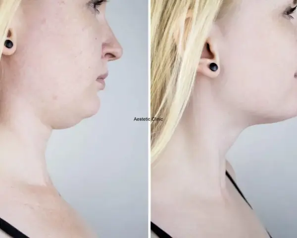 Przed i po zabiegu: widoczna redukcja podwójnego podbródka dzięki lipolizie. Efekty lipolizy podbródka są spektakularne.