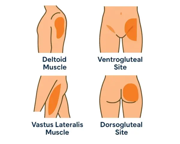 Illustration zeigt Injektionsstellen für eine Muskel-Spritze: Deltamuskel, Ventrogluteal, Vastus lateralis und Dorsogluteal.
