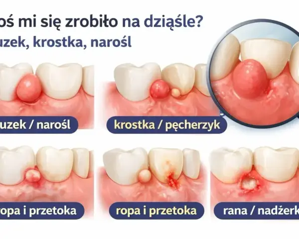 Ilustracja pokazuje różne zmiany na dziąśle: guzek, krostkę, ropień i ranę. Ból dziąsła może objawiać się na wiele sposobów.