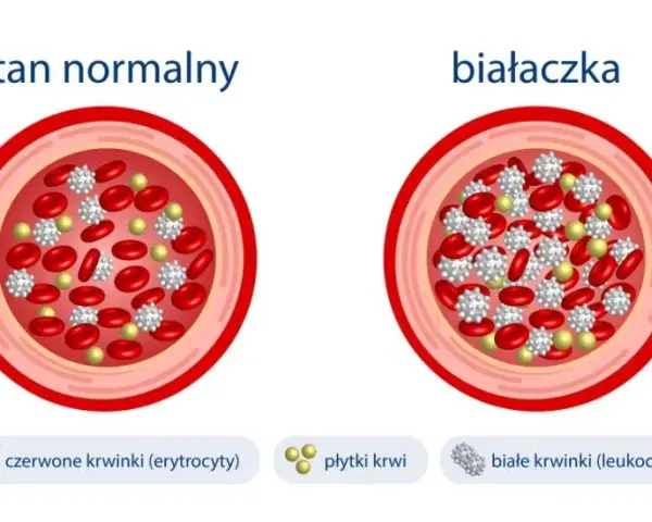 Objawy białaczki u niemowlaka - jak je rozpoznać i kiedy działać