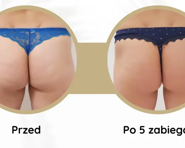 Porównanie pośladków przed i po 5 zabiegach endermologii. Widoczna poprawa jędrności i redukcja cellulitu.