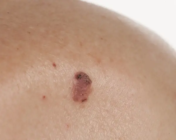 Zbliżenie na skórę z widocznym, nieregularnym znamieniem o różowo-brązowym zabarwieniu.
