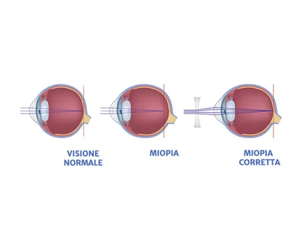 Diagrammi oculari mostrano visione normale, miopia e miopia corretta. I sintomi della miopia degenerativa sono visibili nel secondo occhio.