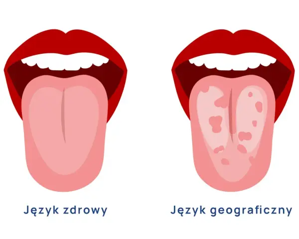 Dwa języki: jeden zdrowy, drugi z plamami, przypominający mapę.