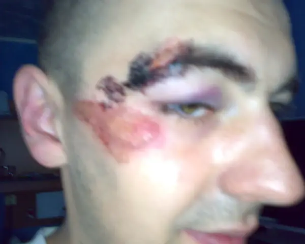 Rozcięty łuk brwiowy z siniakiem i otarciem na policzku.