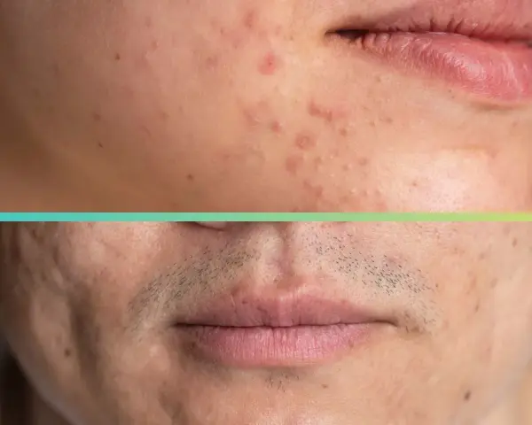 Primo piano di un volto con macchie da acne, prima e dopo il trattamento dermatologico.