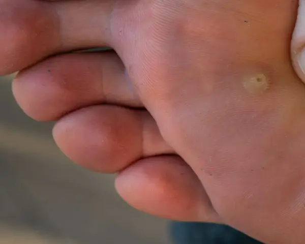 Gros plan sur la plante d'un pied, montrant les empreintes digitales de la peau et une petite verrue au pied.