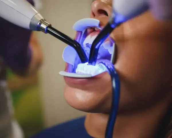 Jak wygląda wybielanie zębów u dentysty? Przewodnik krok po kroku