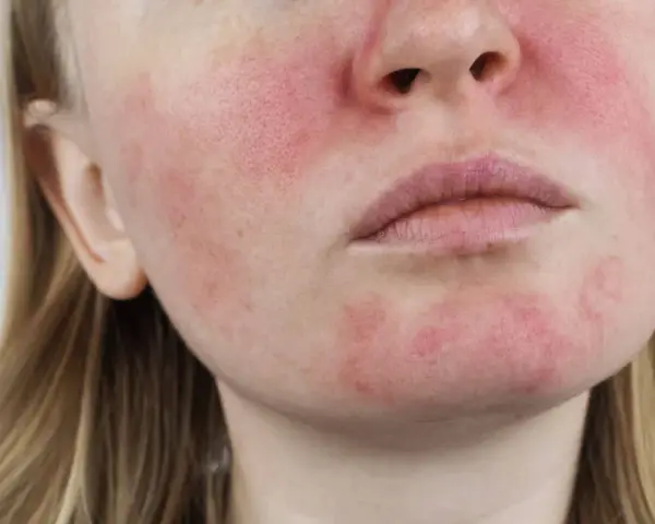 Nahaufnahme eines Gesichts mit Rötungen und sichtbaren Poren, die auf Rosacea und fettige Haut hindeuten.