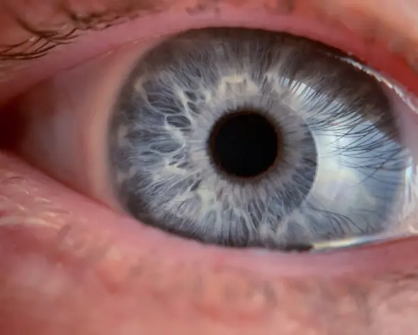 Occhio azzurro con iride dettagliata. Il trabeculectomia decorso post operatorio è in fase di guarigione, mostrando un occhio sano e vigile.