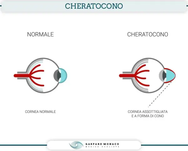 Confronto tra occhio normale e occhio con cheratocono, evidenziando la cornea assottigliata e a forma di cono, uno dei principali cheratocono sintomi.
