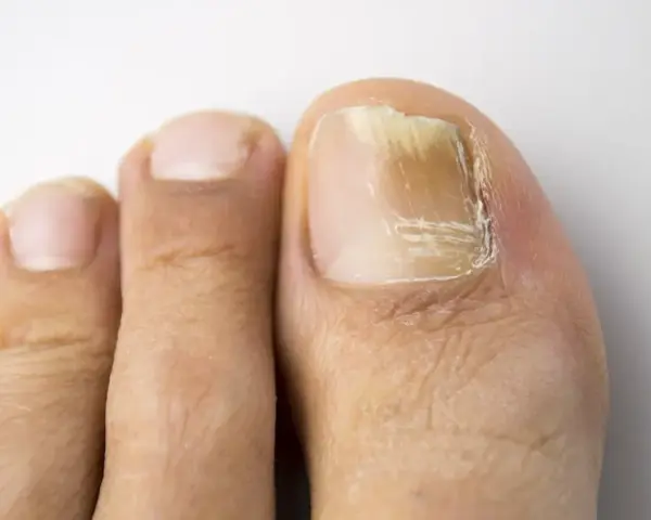 Gros plan sur un ongle de pied atteint de mycose, jauni et épaissi. Une solution naturelle à base d'huile essentielle pourrait aider.