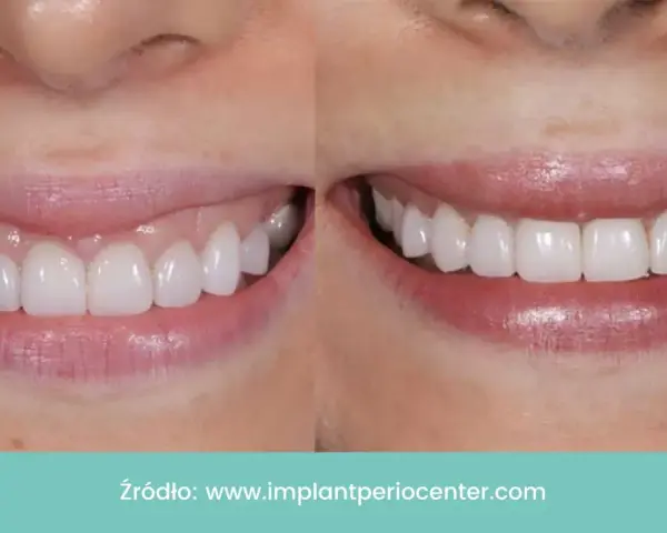 Uśmiech przed i po: zredukowany gummy smile, odsłonięte piękne, białe zęby.