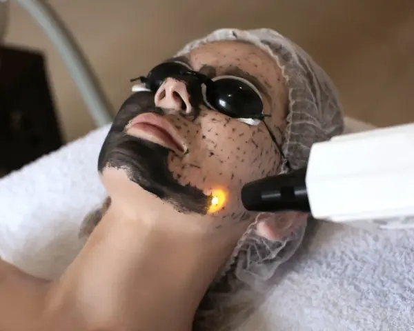 Kobieta z maską węglową na twarzy przechodzi zabieg laserowy.