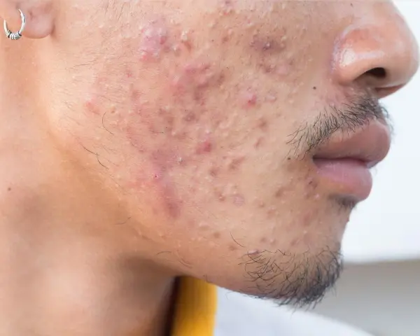 Primer plano de un rostro con acné severo, mostrando granos de pus grandes y enrojecimiento.