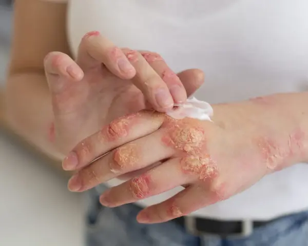 Manos con psoriasis, aplicando crema para aliviar la piel seca y escamosa.