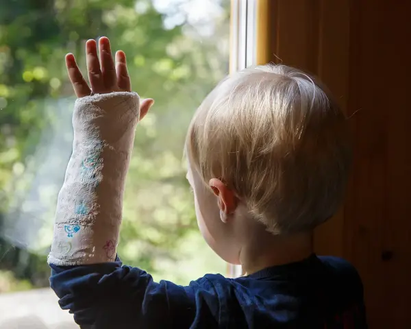 Kind mit Gips am Arm, das durch ein Fenster schaut. Ein gebrochenes Handgelenk bei einem Kind ist schmerzhaft, aber die bunte Gipsbinde macht es erträglicher.
