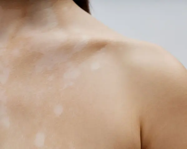 Piel con manchas claras, como si fueran **hongos en la espalda**, cubriendo el cuello y hombro.