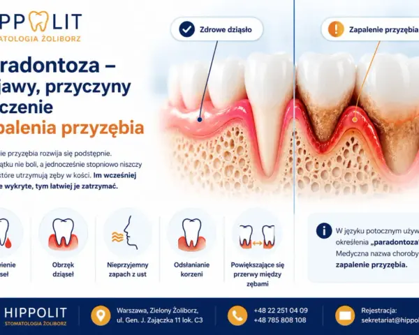 Zapalenie przyzębia: objawy to krwawienie, obrzęk dziąseł, nieprzyjemny zapach, odsłonięte korzenie i przerwy między zębami. Wczesne wykrycie kluczowe.