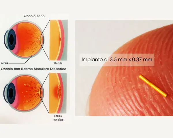 Illustrazione occhio sano vs. occhio con edema maculare diabetico, causa di edema retinico. Impianto microscopico.