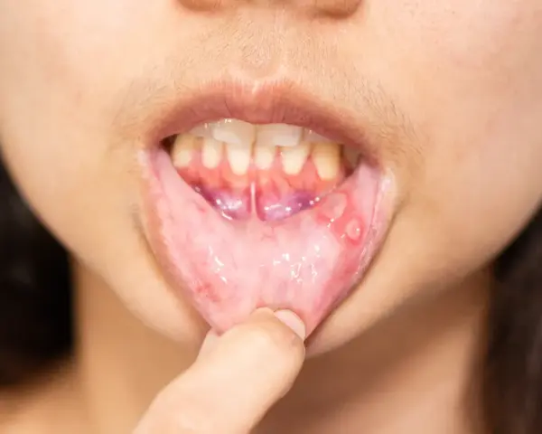 Aftę ustne, które mogą wymagać leczenia leukoplakii, widoczne na wewnętrznej stronie wargi dolnej.