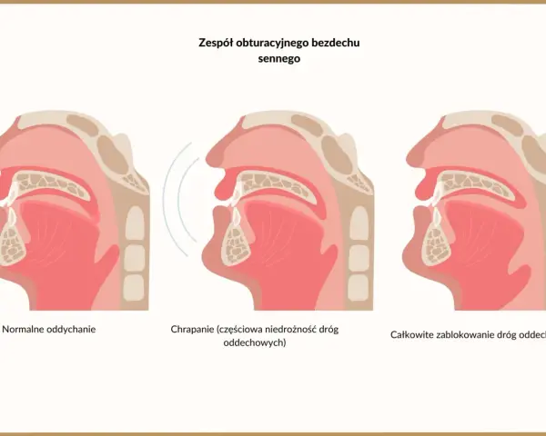 Ilustracja pokazuje przekrój dróg oddechowych: normalne oddychanie, chrapanie (częściowa niedrożność) i całkowite zablokowanie, które może powodować brak oddechu w nocy nerwica.
