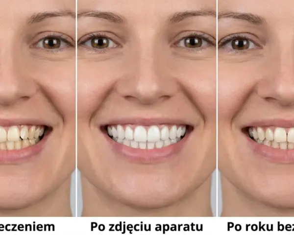 Triptych uśmiechniętej kobiety pokazujący zęby przed leczeniem, po zdjęciu aparatu i po roku bez retencji.