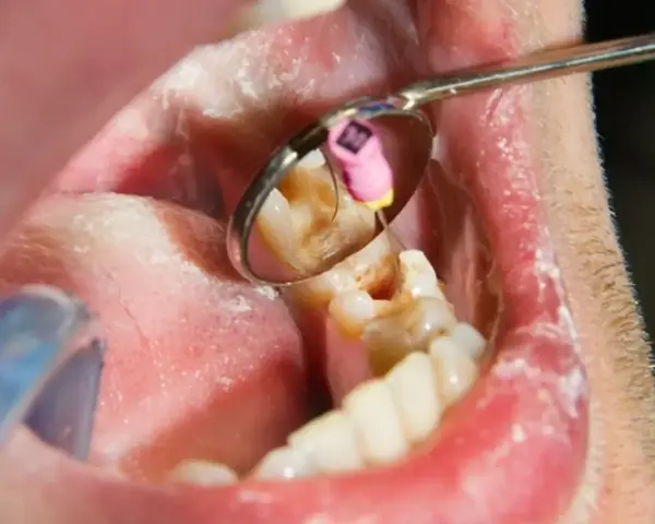 Zabieg stomatologiczny: martwy ząb jedynka w trakcie leczenia kanałowego. Widoczny instrument i lusterko dentystyczne.