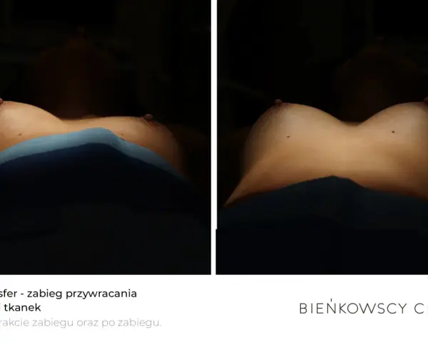 Lipotransfer biustu: porównanie efektów przed i po zabiegu. Widoczne piersi z zaznaczonymi punktami.