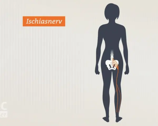 Illustration zeigt den Ischiasnerv, der vom Rückenmark bis ins Bein verläuft. Reizung kann zu Ischias Schmerz führen.