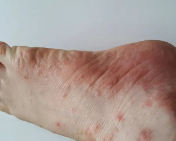 Pied rouge et irrité, avec des petites bosses et des zones sèches, signe d'un pied qui gratte.
