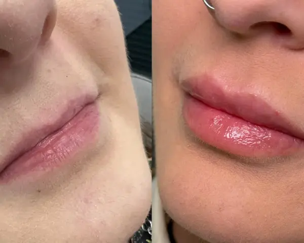 Powiększanie ust: Kwas hialuronowy, lip lift czy domowe triki?