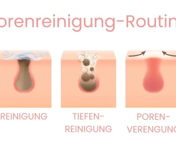Illustration zeigt, woher kommen Mitesser: Talg und abgestorbene Hautzellen verstopfen Poren. Reinigung und Porenverengung helfen.