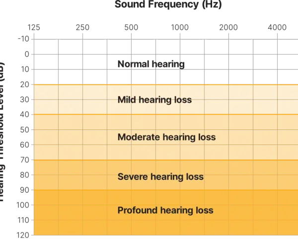 Graphique montrant les niveaux de perte auditive en fonction de la fréquence et du bruit decibel. De "normal hearing" à "profound hearing loss".
