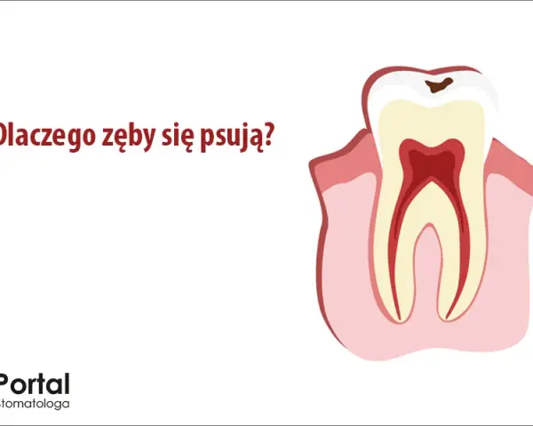 Od czego psują się zęby? Odkryj prawdziwe przyczyny i chroń uśmiech