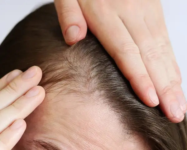 Manos tocando el cuero cabelludo, mostrando finos cabellos y piel. Podría indicar dolor cuero cabelludo o preocupación por la pérdida de cabello.