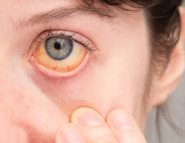 Jadłowstręt psychiczny objawy: jak rozpoznać niebezpieczne symptomy