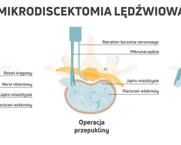 Ilustracja pokazuje mikrodiscektomię lędźwiową: przepuklinę, operację i usunięcie fragmentu krążka. Pamiętaj, czego nie wolno robić po operacji kręgosłupa lędźwiowego.