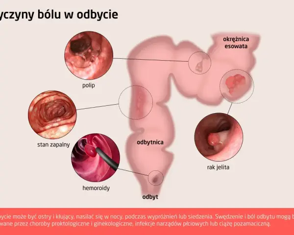 Ilustracja pokazuje przyczyny bólu w odbycie: polip, stan zapalny, hemoroidy, raka jelita, okrężnicę esowatą.