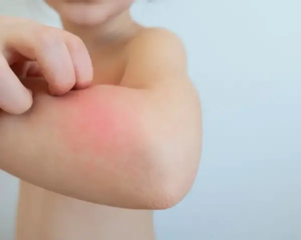 Kind kratzt sich am roten, geschwollenen Arm. Tipps, wie man Schnakenstiche behandeln kann, sind hier wichtig.