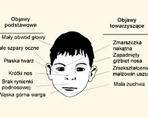 Ilustracja przedstawia cechy twarzy dziecka z FASD: mały obwód głowy, płaska twarz, krótki nos, wąska górna warga, zmarszczka nakątna, zapadnięty grzbiet nosa.