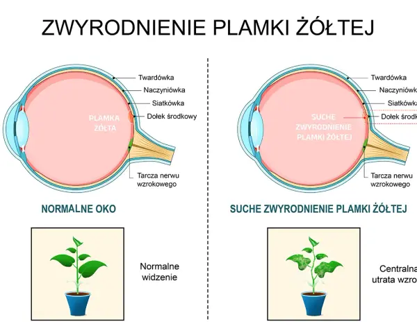 Porównanie zdrowego oka z suchym zwyrodnieniem plamki żółtej. Pokazuje, jak szybko powiększa się otwór plamki żółtej, prowadząc do utraty wzroku.